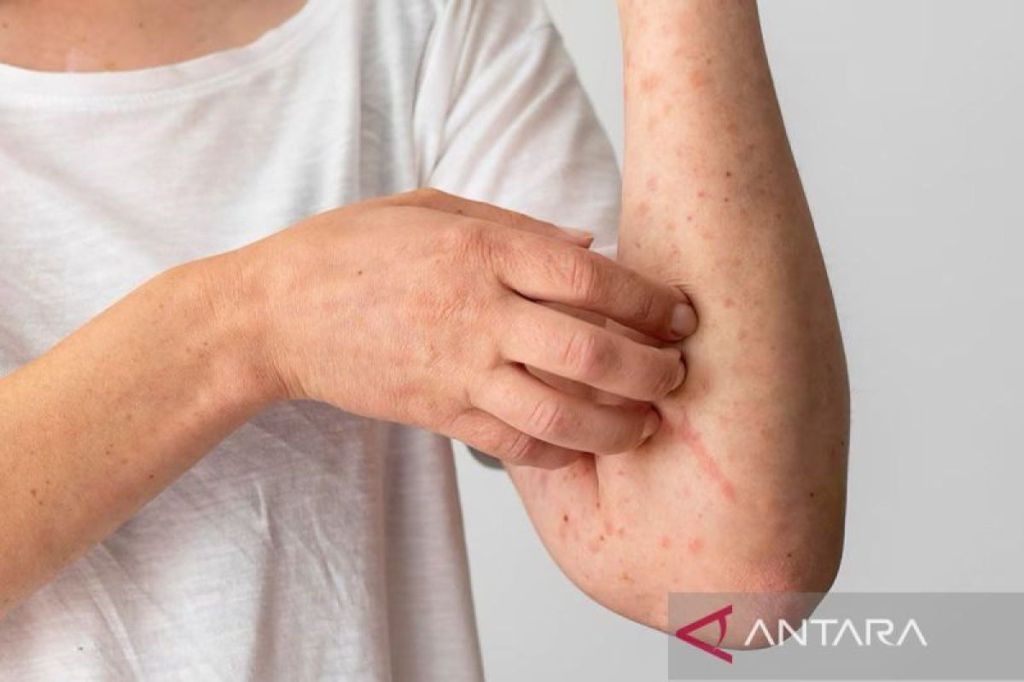 Istirahat yang cukup kurangi risiko terserang&nbsp;lupus