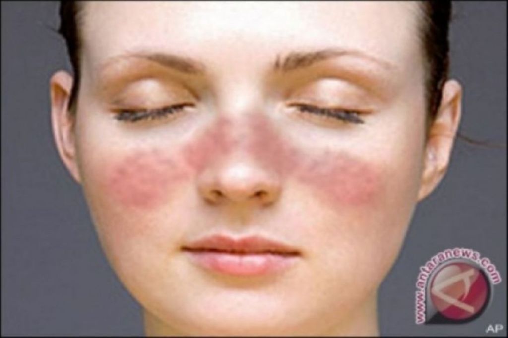 Alasan anak perempuan lebih berisiko terkena lupus dibanding&nbsp;laki-laki